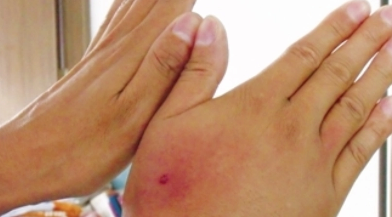 蜂叮急救 蜂叮急救